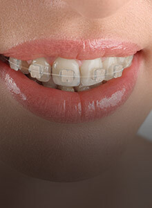Closeup of smile with tooth colored braces